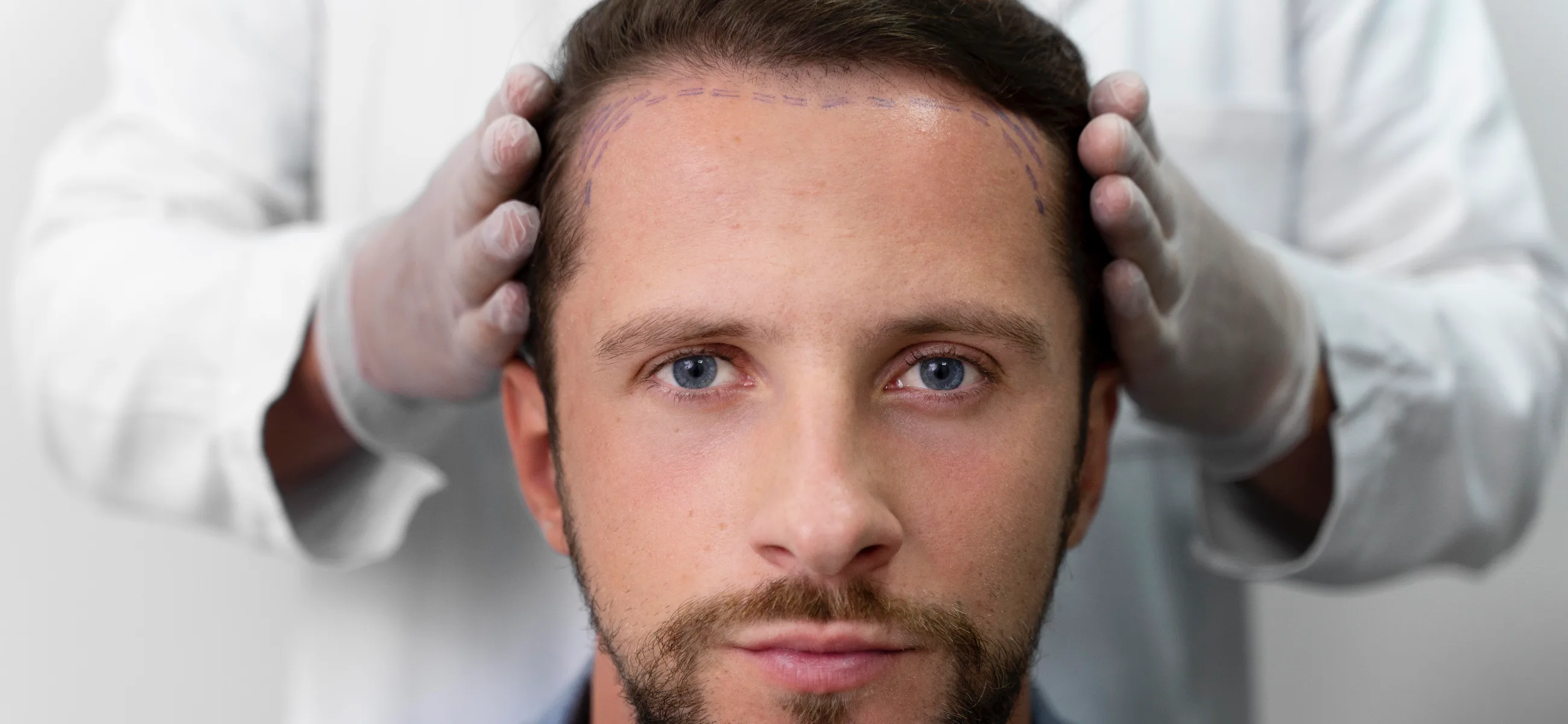 The cost of hair transplant