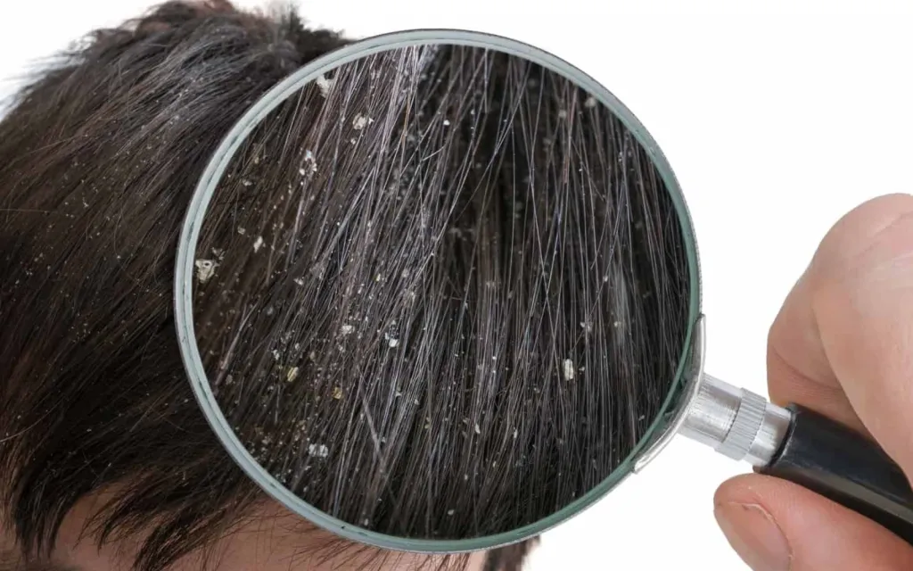 What causes dry scalp? 