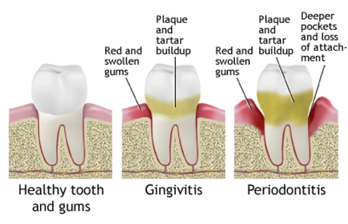 What is gingivitis?