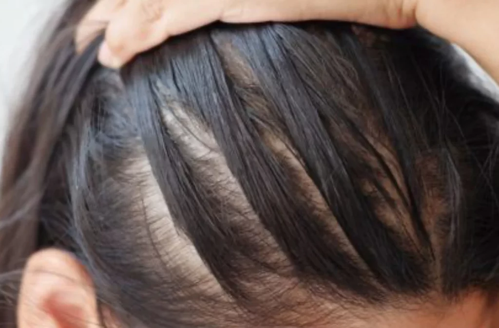 Higher risk of oily hair