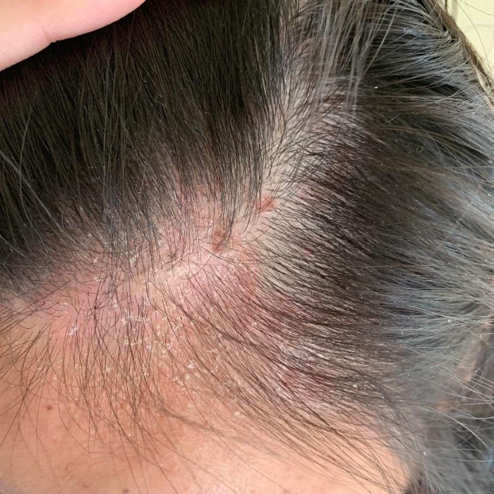 Itchy scalp caused by using overuse dry shampoo