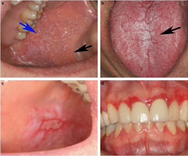 Oral lichen planus