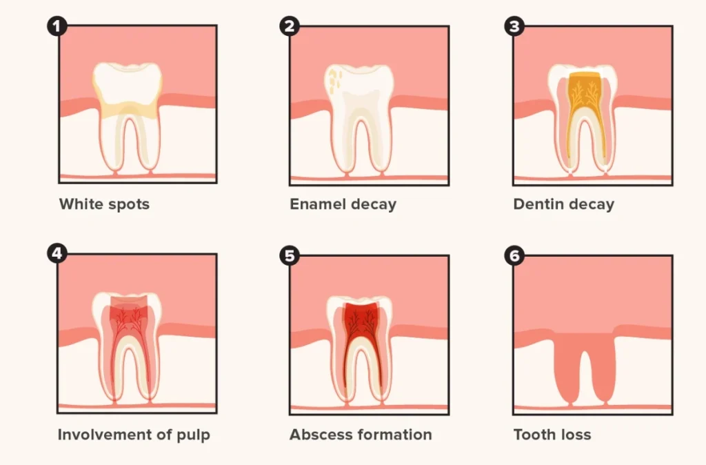 Stages and types of dental caries