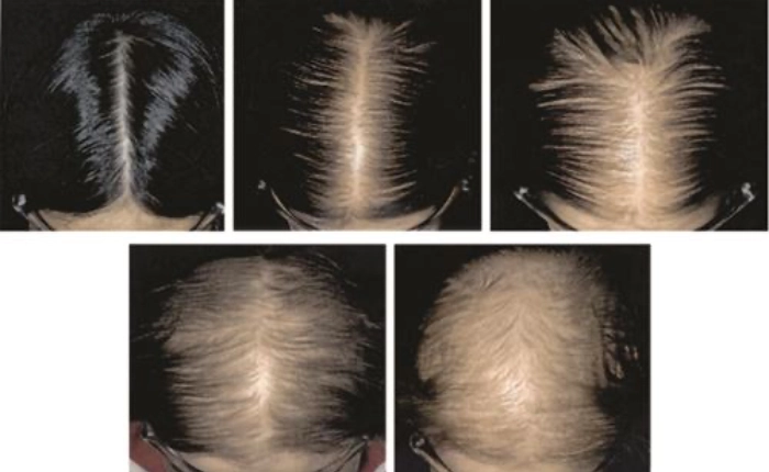 Stages of hair loss | Hair loss pattern