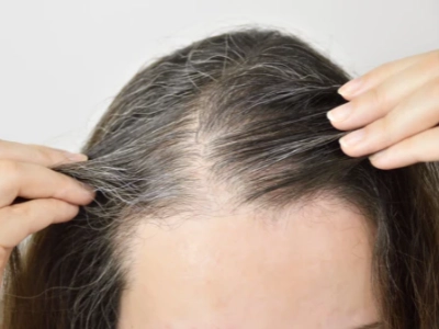 Telogen effluvium | What cuases sudden hair loss?