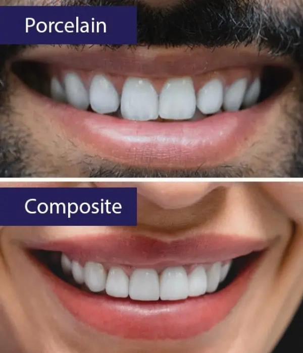 Types of dental veneers