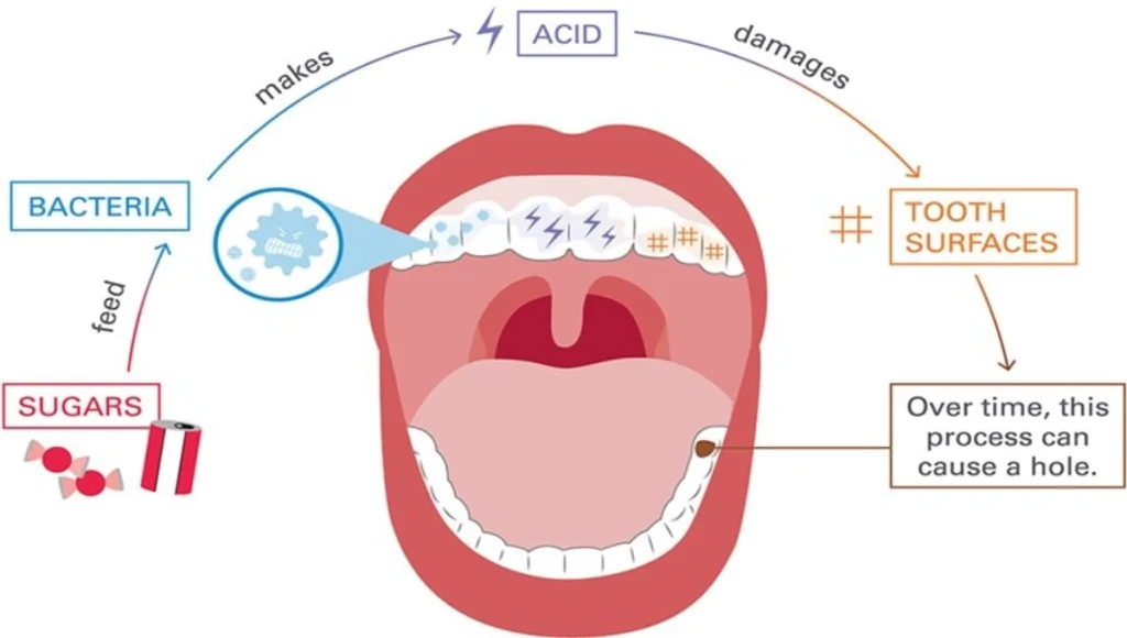 What are dental caries, and how are they caused? 