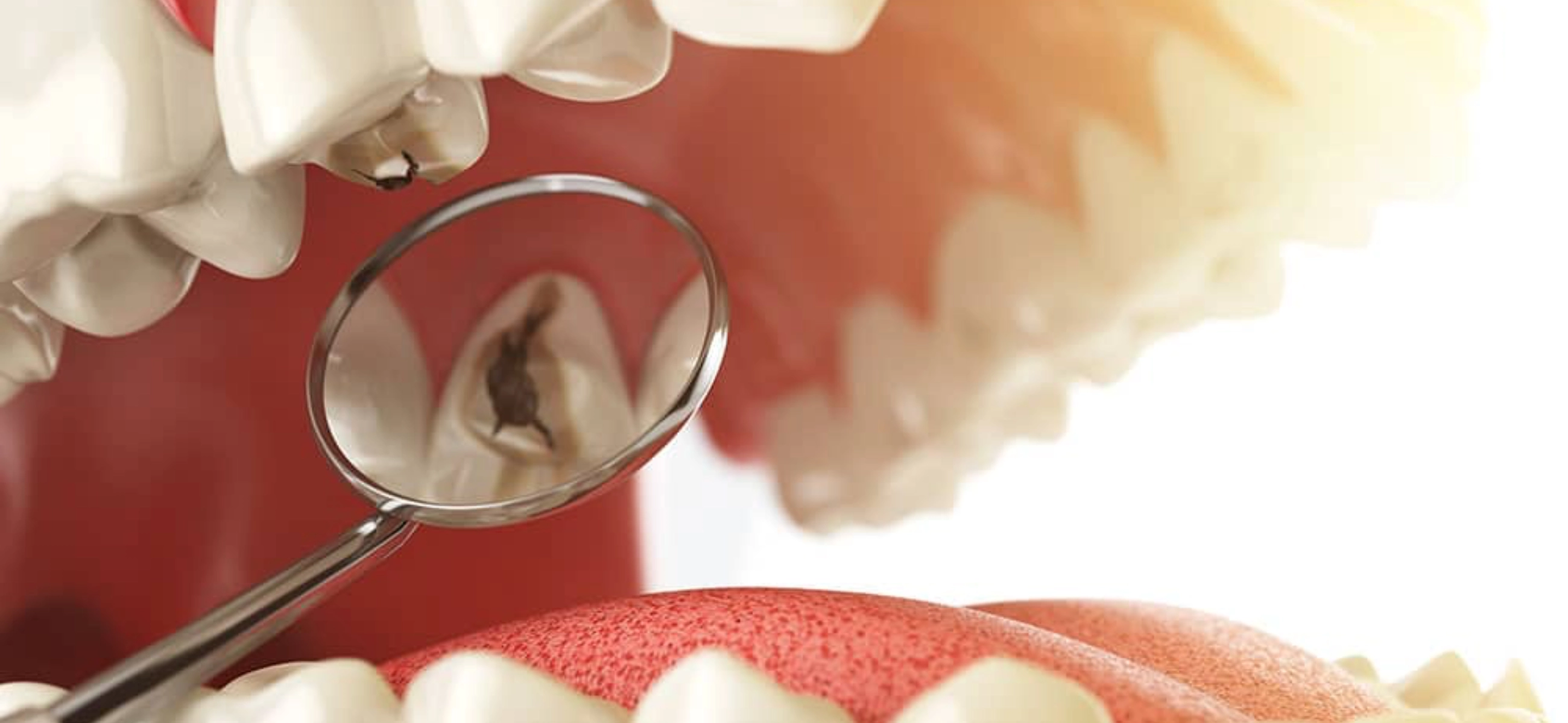 What are dental caries, and how can they be prevented?