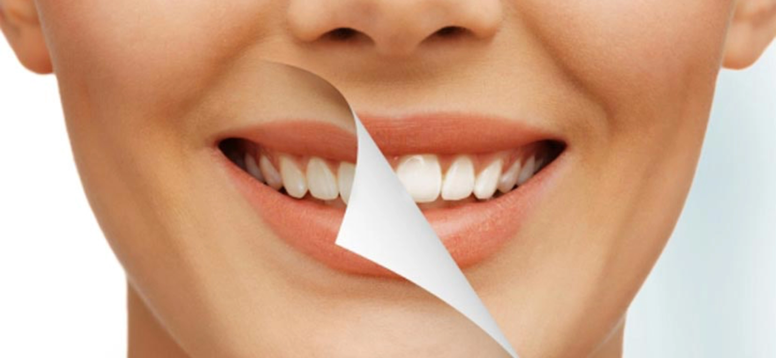 What are dental veneers, and are they right for me?