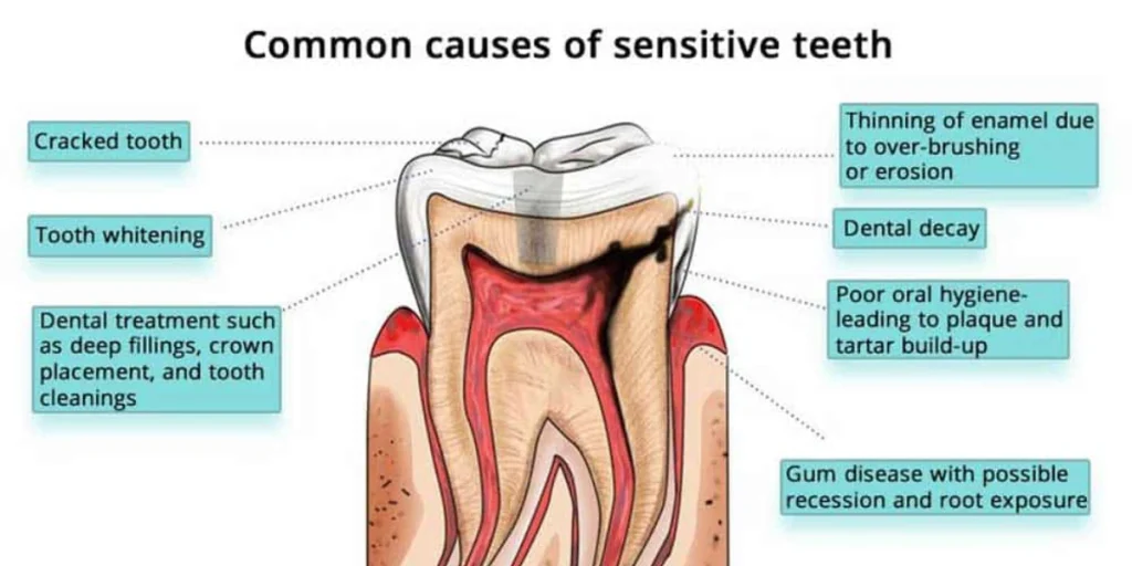 What causes teeth sensitivity