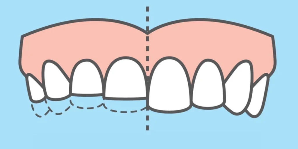 Bruxism - What causes toothache?