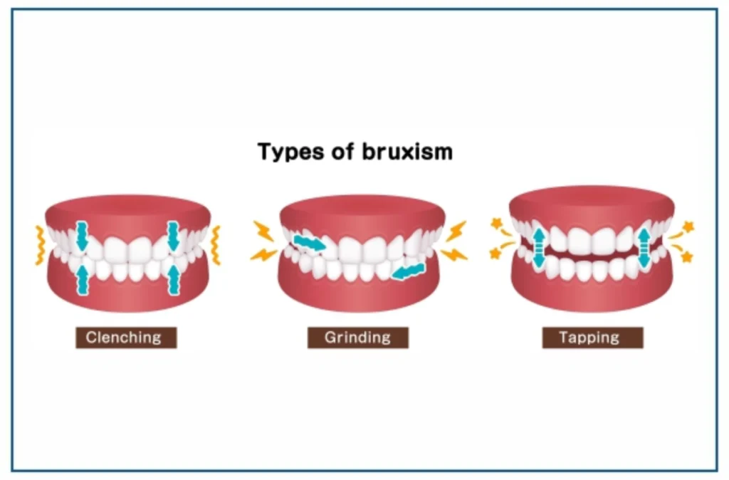 Bruxism (Teeth grinding)