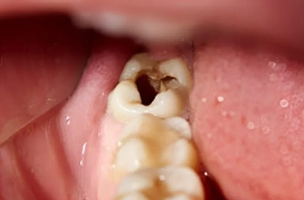 Cavities - What causes toothache?