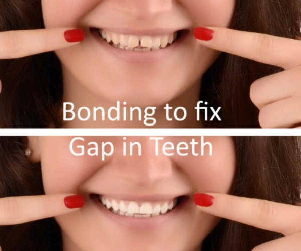 Dental bonding - How to straighten teeth without braces at home naturally?