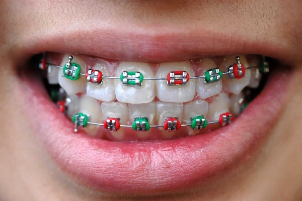 DIY braces kits - How to straighten teeth without braces at home naturally?