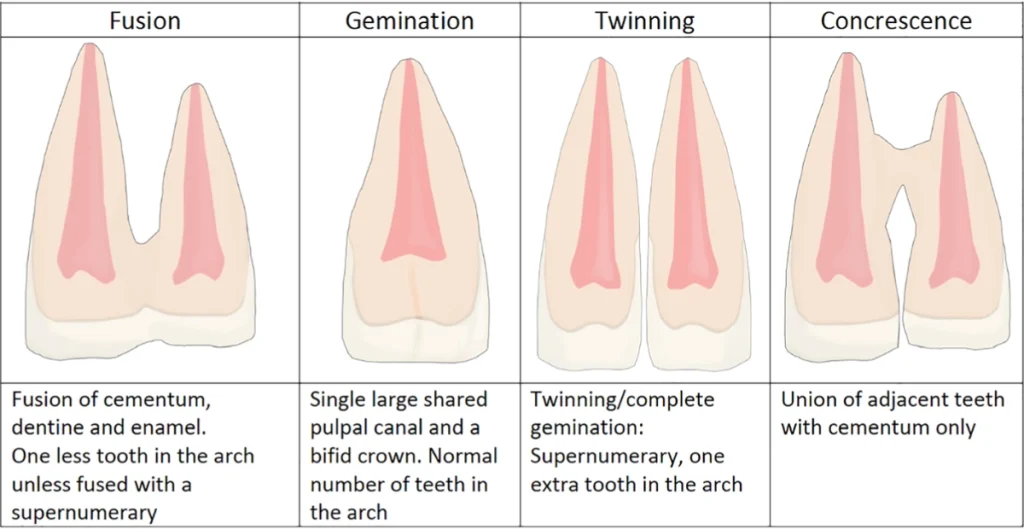 Double tooth gemination