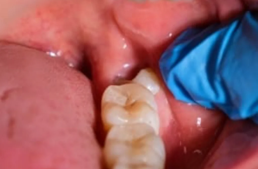 Eruption of wisdom teeth - What causes toothache?