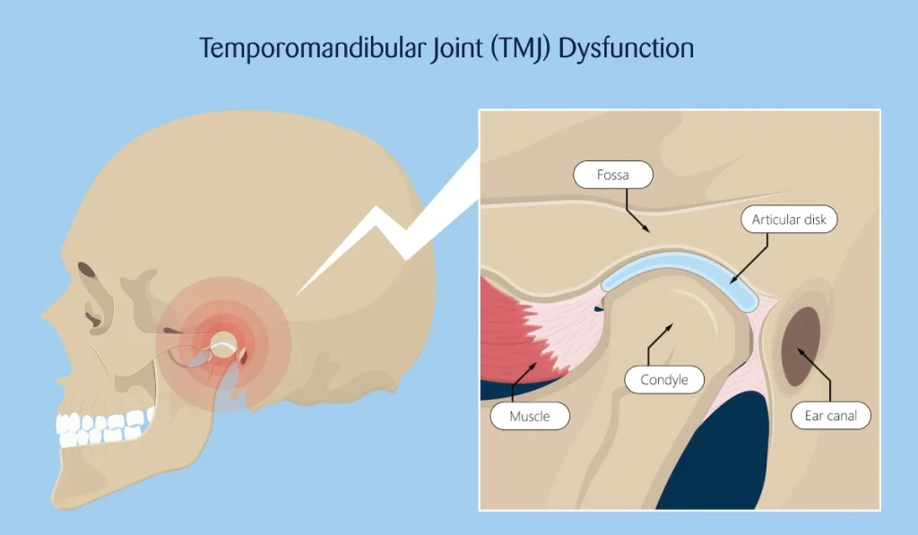 Temporomandibular Joint (TMJ) Dysfunction