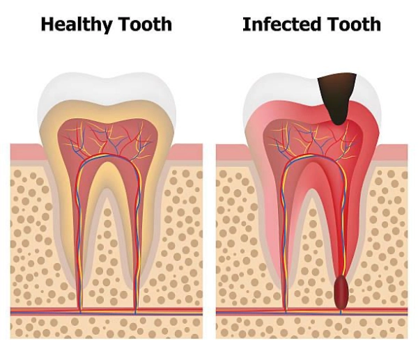 Infection and inflammation