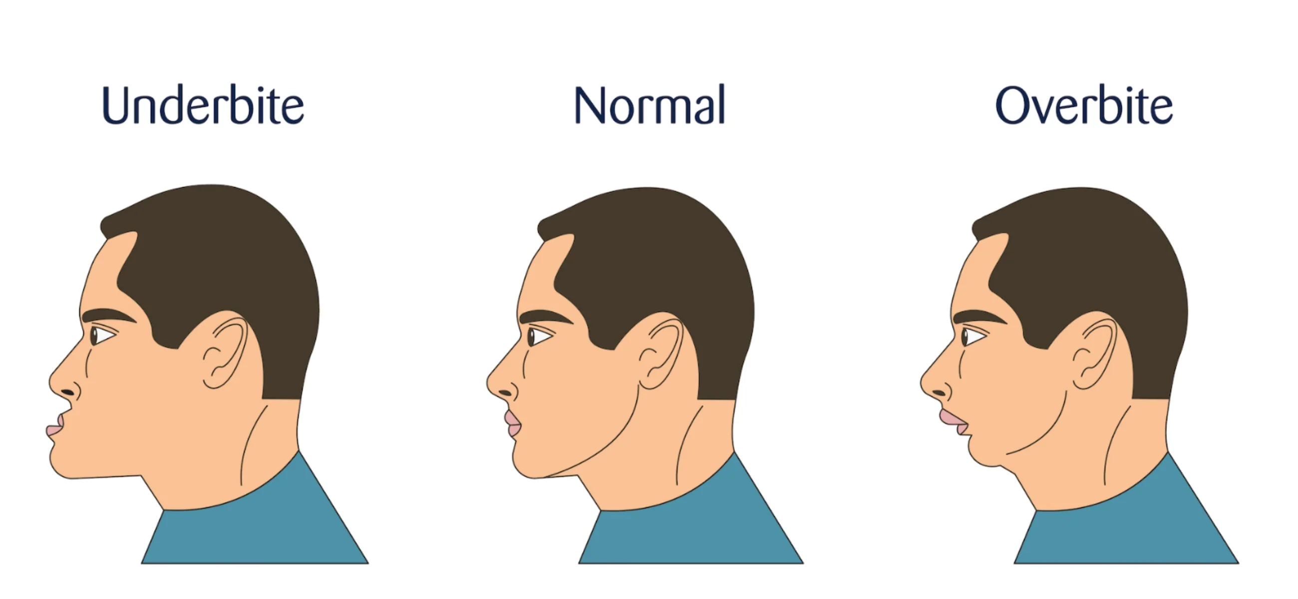 Overbite vs underbite: Differences to be aware of and how to treat