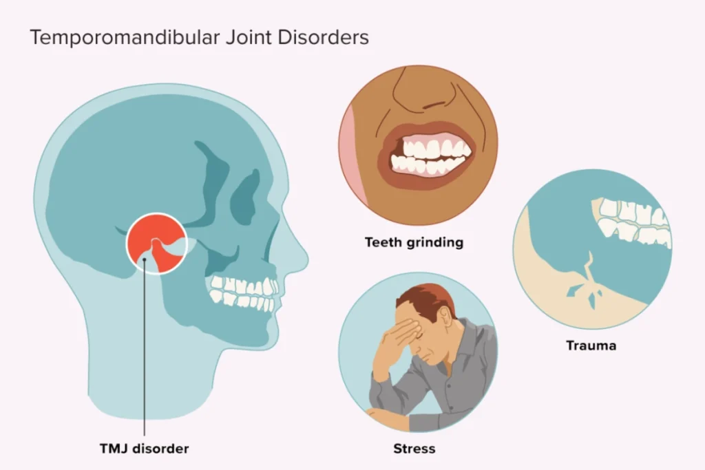 Temporomandibular Joint Disorder (TMJ)