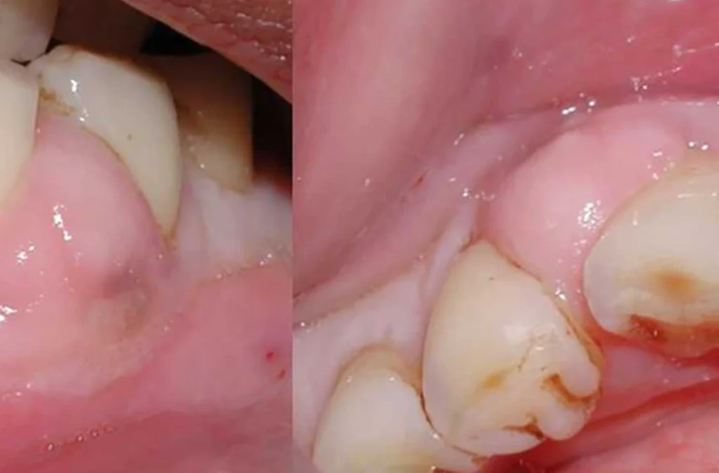 Tooth abscess - What causes toothache?