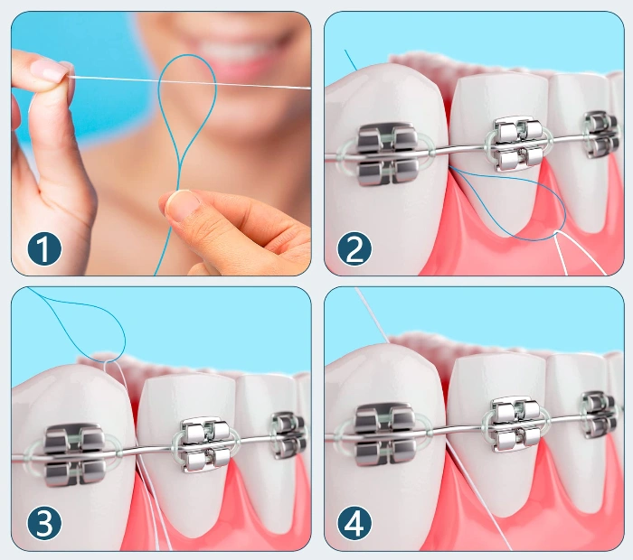 Use a dental floss threader: Tutorial